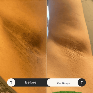Before and After Dark Spot Clearer — Skin Lightening Cream