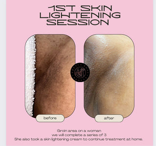 Colorlite Plus — Corrective Skin Lightening Serum Before and After